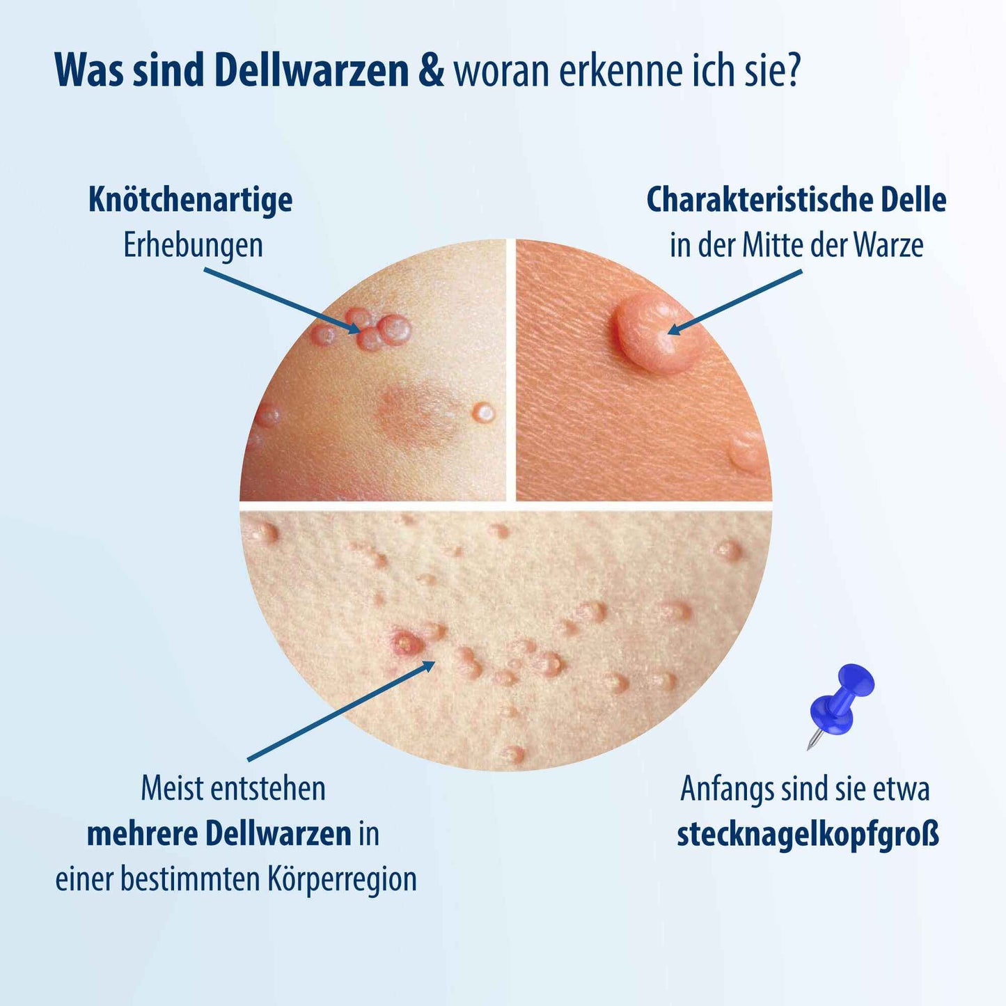 EVOLSIN Molluscum Contagiosum Solution