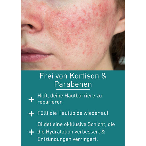 N1 Rosacea Cream - UKDorf
