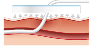 BIOPATCH antimicrobial wound dressing 2.5cm